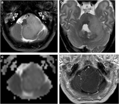 Congenital Extra-Ventricular (Ganglio)Neurocytoma of the Brain Stem: A Case Report